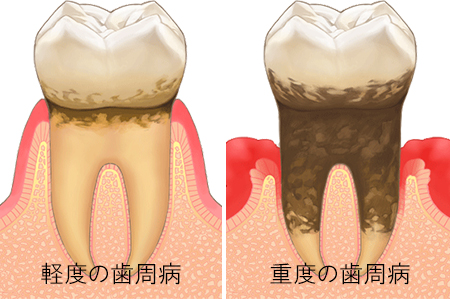 歯周病の画像